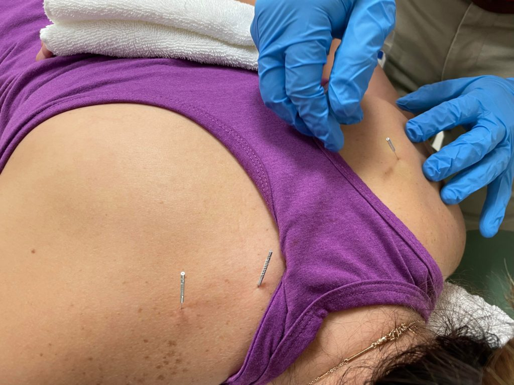 Dry needling Singapore to relieve neck pain & RSI