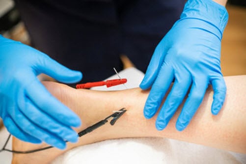 Dry needling treatment for ankle pain as part of chiropractic care in Singapore