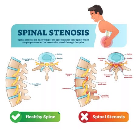 Chiropractic solutions for spinal stenosis and back pain treatment in Singapore