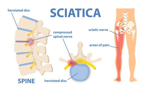 Find effective chiropractic treatments for sciatica pain and spinal care