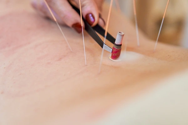 Dry needling treatment has less risk of complication