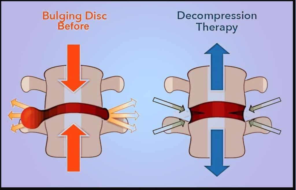 Slipped disc treatment Singapore